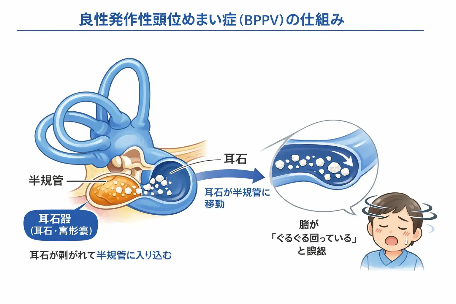 眩暈(めまい) めまいについて | 浅野耳鼻いんこう科医院